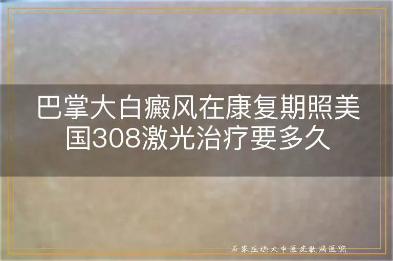 巴掌大白癜风在康复期照美国308激光治疗要多久