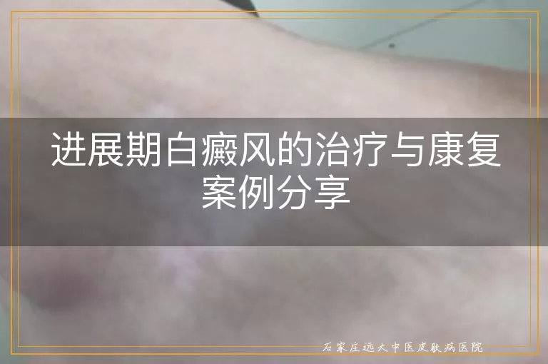 进展期白癜风的治疗与康复案例分享