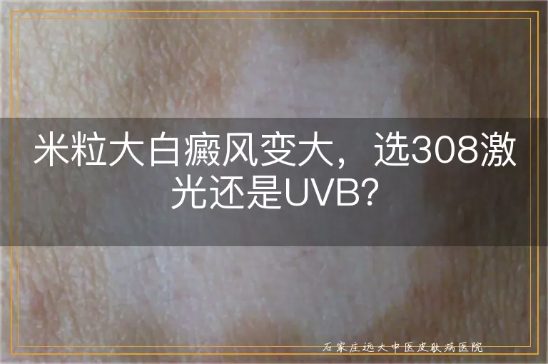 米粒大白癜风变大，选308激光还是UVB？