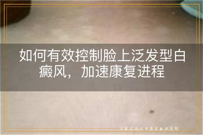 如何有效控制脸上泛发型白癜风，加速康复进程