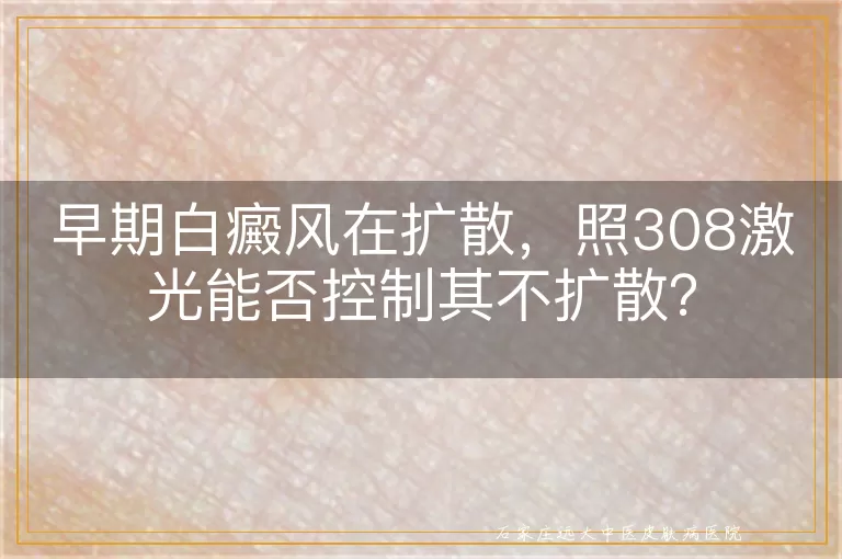 早期白癜风在扩散，照308激光能否控制其不扩散？