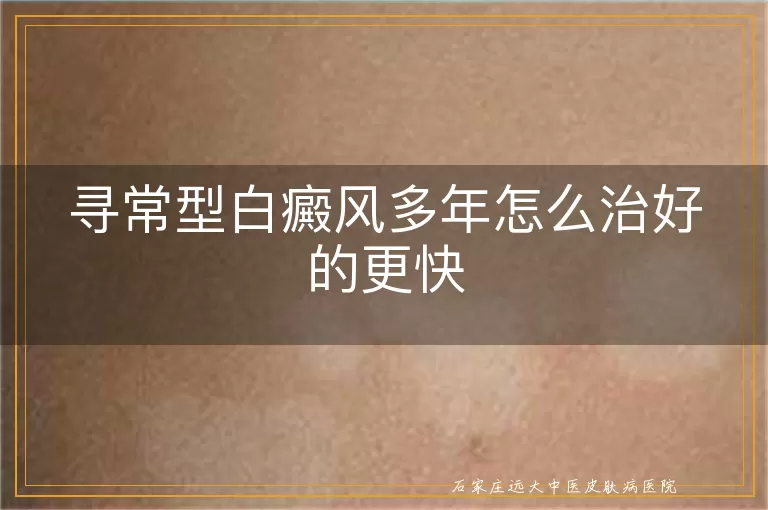寻常型白癜风多年怎么治好的更快