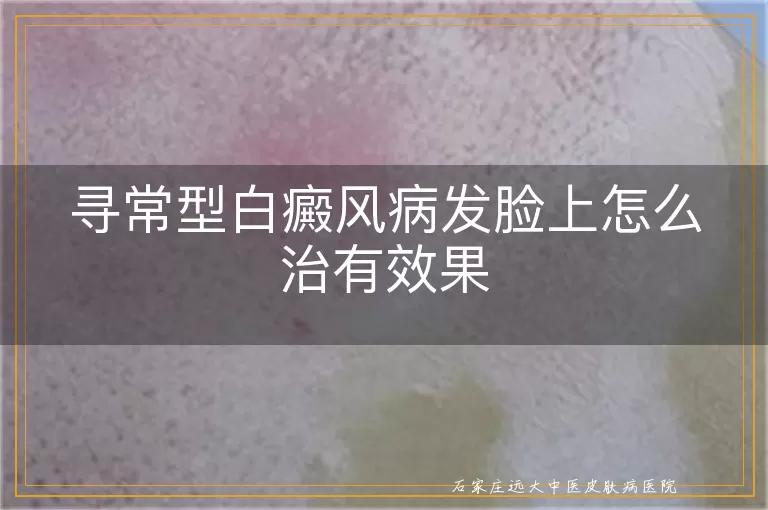 寻常型白癜风病发脸上怎么治有效果