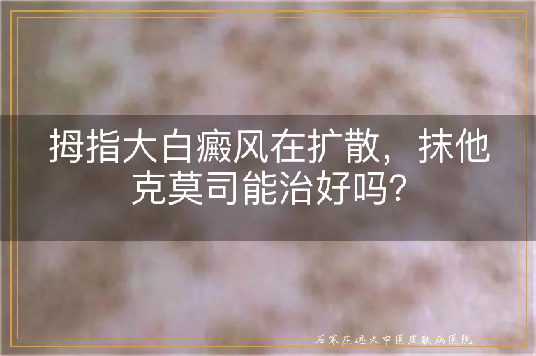 拇指大白癜风在扩散，抹他克莫司能治好吗？