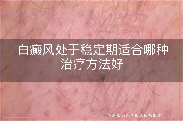 白癜风处于稳定期适合哪种治疗方法好