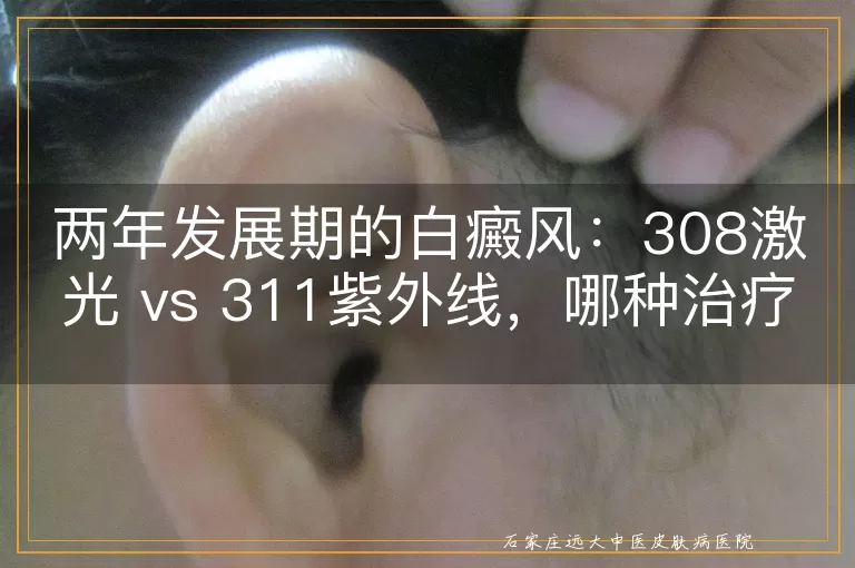两年发展期的白癜风：308激光 vs 311紫外线，哪种治疗效果更佳？