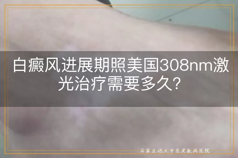 白癜风进展期照美国308nm激光治疗需要多久？