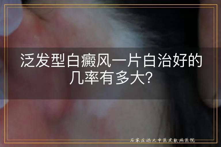 泛发型白癜风一片白治好的几率有多大？