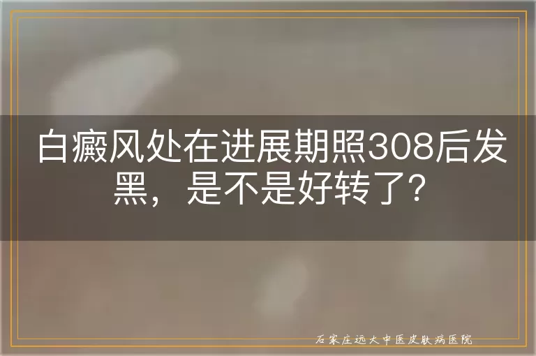 白癜风处在进展期照308后发黑，是不是好转了？