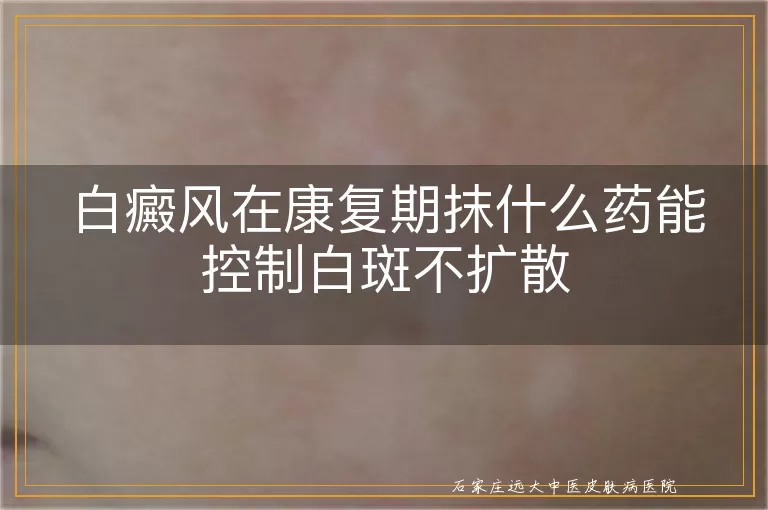 白癜风在康复期抹什么药能控制白斑不扩散