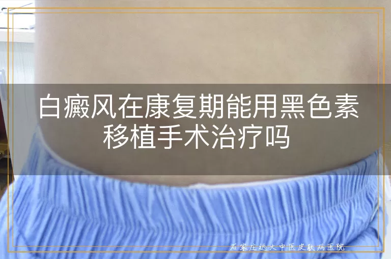 白癜风在康复期能用黑色素移植手术治疗吗