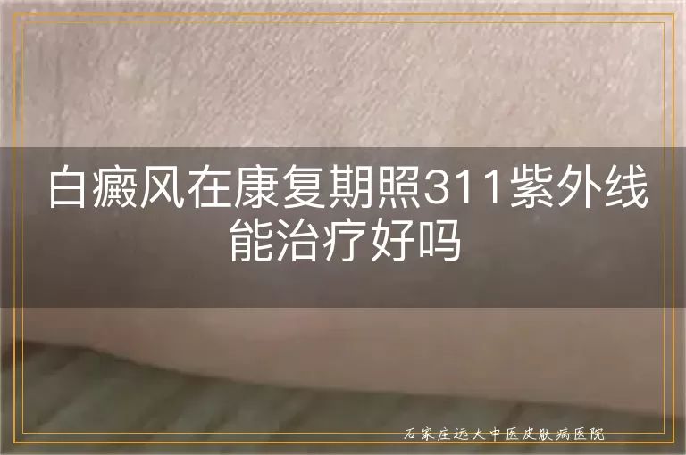 白癜风在康复期照311紫外线能治疗好吗