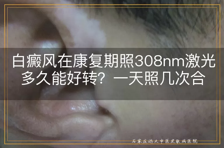 白癜风在康复期照308nm激光多久能好转？一天照几次合适？