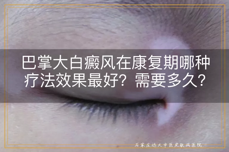巴掌大白癜风在康复期哪种疗法效果最好？需要多久？