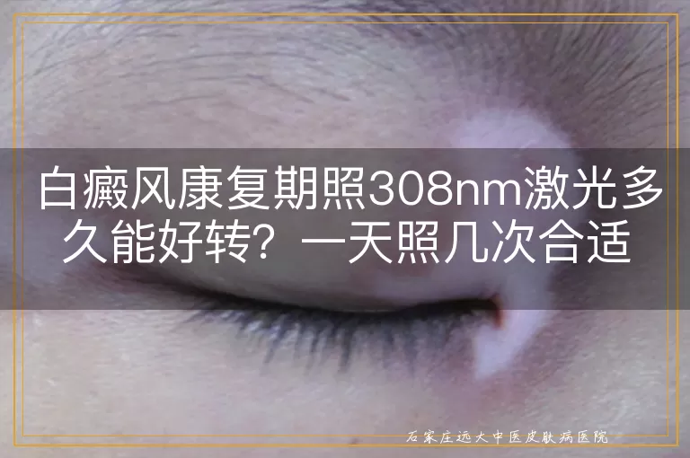 白癜风康复期照308nm激光多久能好转？一天照几次合适？