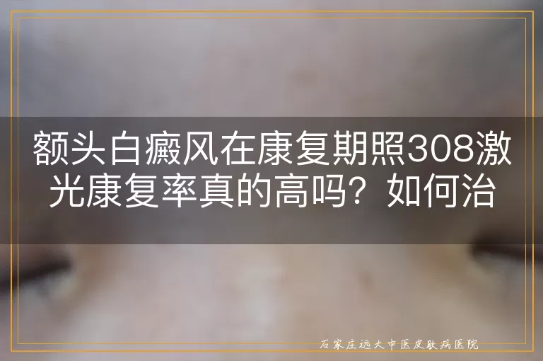 额头白癜风在康复期照308激光康复率真的高吗？如何治疗？