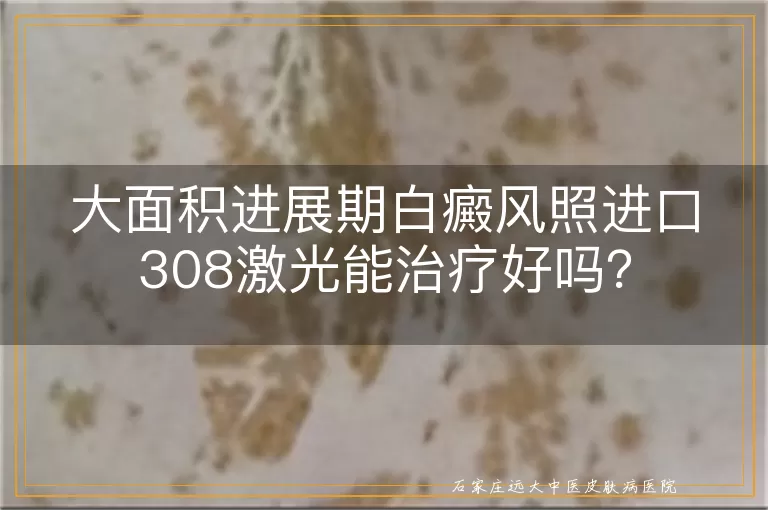 大面积进展期白癜风照进口308激光能治疗好吗？