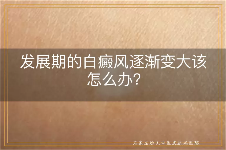 发展期的白癜风逐渐变大该怎么办？