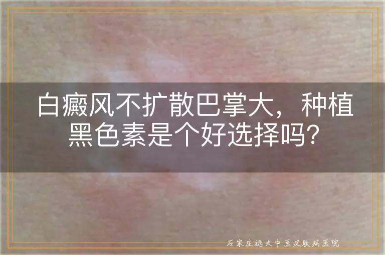 白癜风不扩散巴掌大，种植黑色素是个好选择吗？