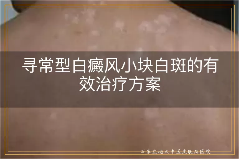 寻常型白癜风小块白斑的有效治疗方案