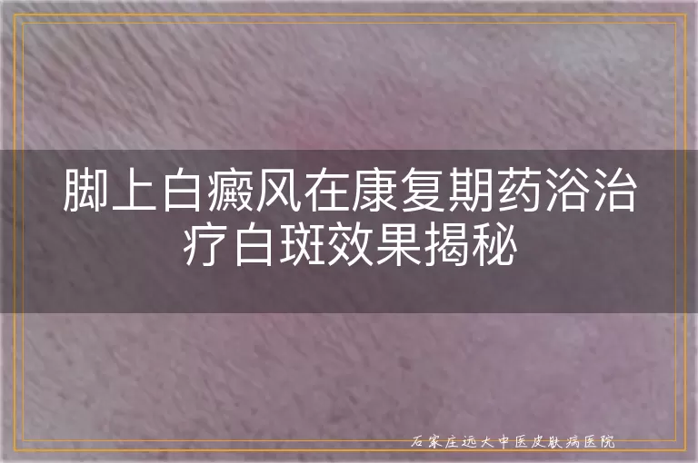 脚上白癜风在康复期药浴治疗白斑效果揭秘