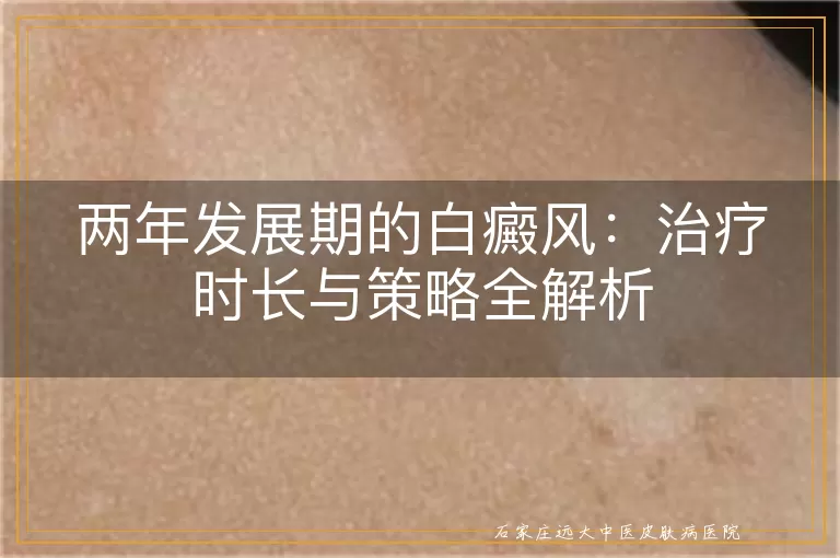两年发展期的白癜风：治疗时长与策略全解析