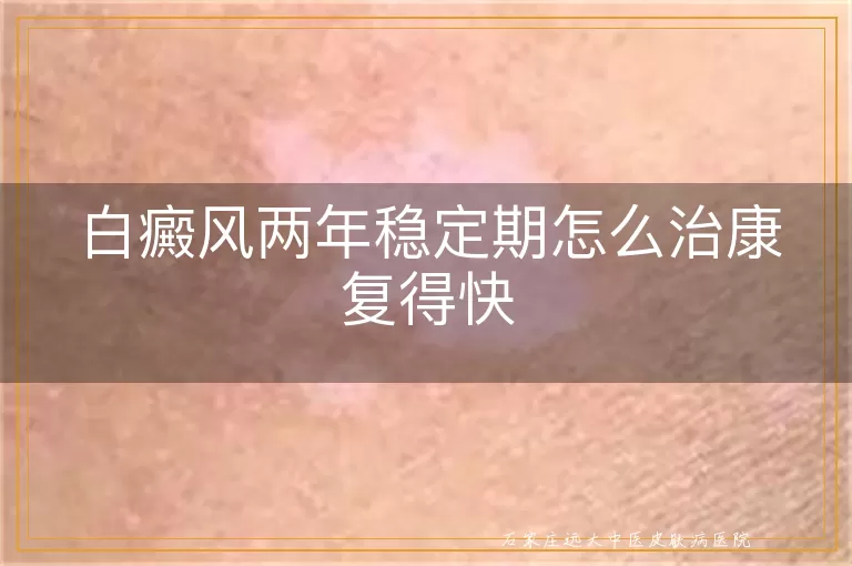 白癜风两年稳定期怎么治康复得快