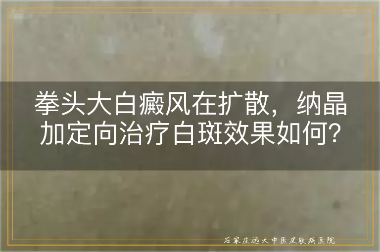 拳头大白癜风在扩散，纳晶加定向治疗白斑效果如何？