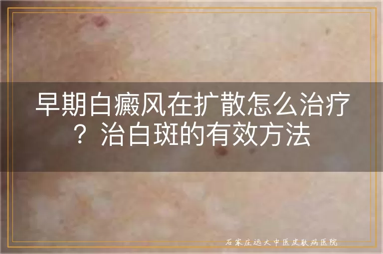 早期白癜风在扩散怎么治疗？治白斑的有效方法