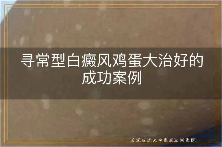 寻常型白癜风鸡蛋大治好的成功案例