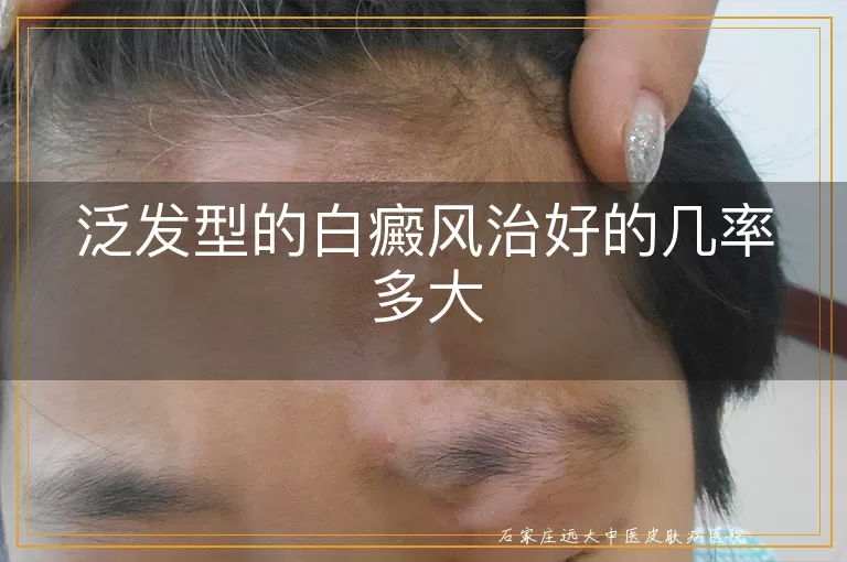 泛发型的白癜风治好的几率多大