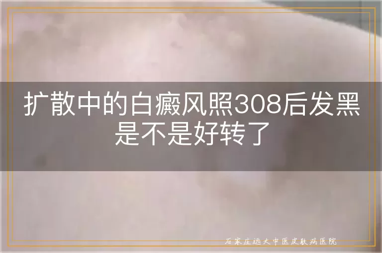 扩散中的白癜风照308后发黑是不是好转了