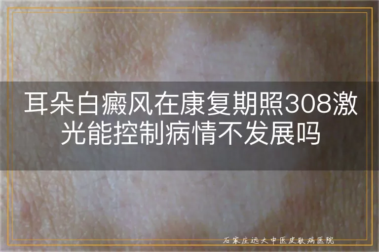 耳朵白癜风在康复期照308激光能控制病情不发展吗