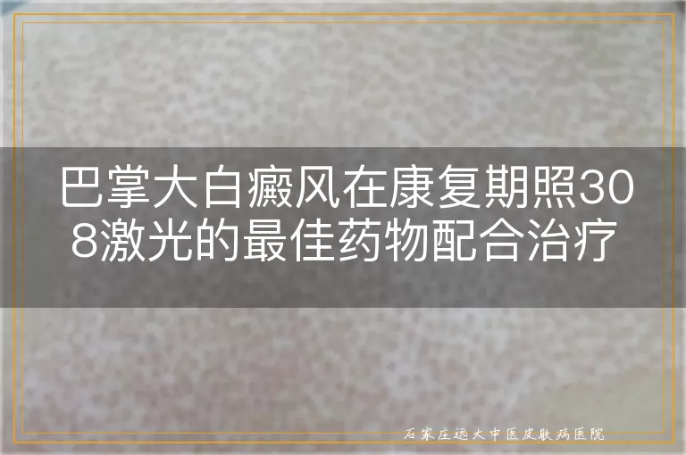 巴掌大白癜风在康复期照308激光的最佳药物配合治疗
