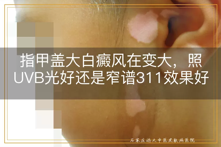 指甲盖大白癜风在变大，照UVB光好还是窄谱311效果好？
