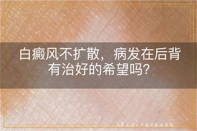 白癜风不扩散，病发在后背有治好的希望吗？