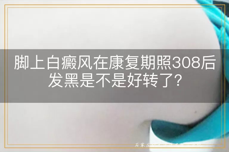 脚上白癜风在康复期照308后发黑是不是好转了？