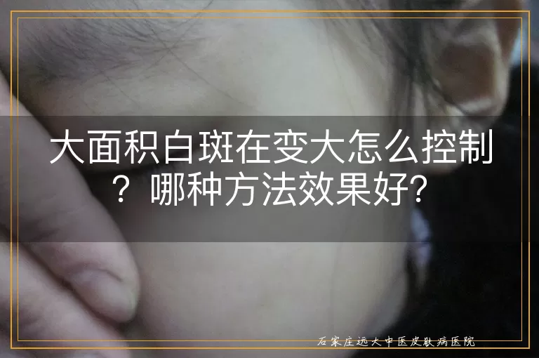 大面积白斑在变大怎么控制？哪种方法效果好？