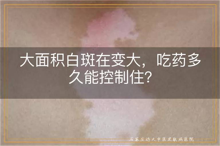 大面积白斑在变大，吃药多久能控制住？