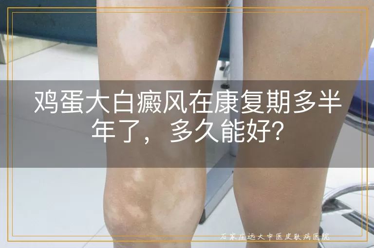 鸡蛋大白癜风在康复期多半年了，多久能好？