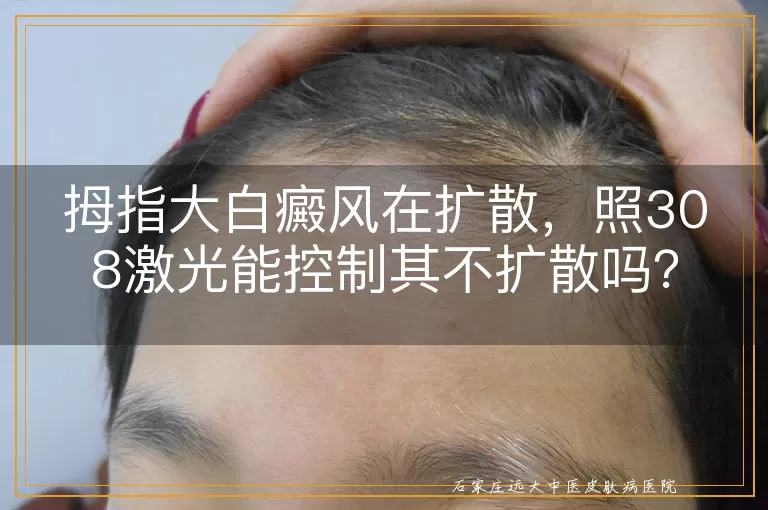 拇指大白癜风在扩散，照308激光能控制其不扩散吗？