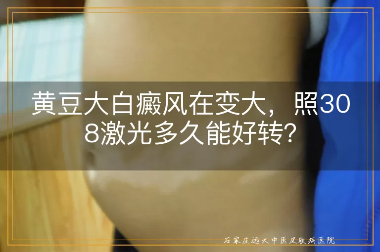 黄豆大白癜风在变大，照308激光多久能好转？