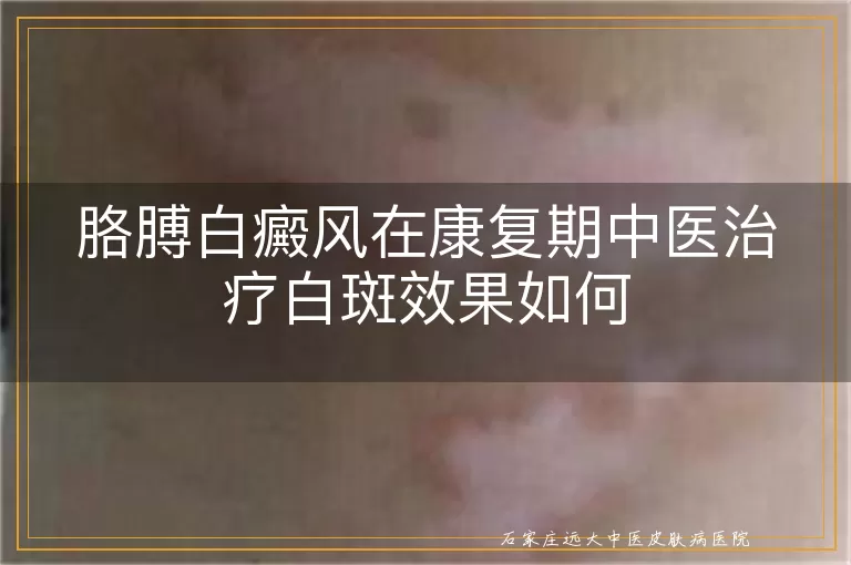 胳膊白癜风在康复期中医治疗白斑效果如何