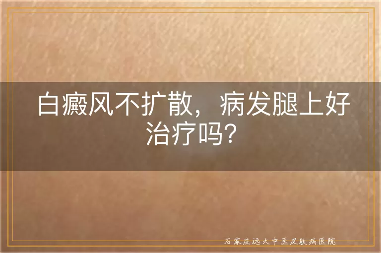 白癜风不扩散，病发腿上好治疗吗？