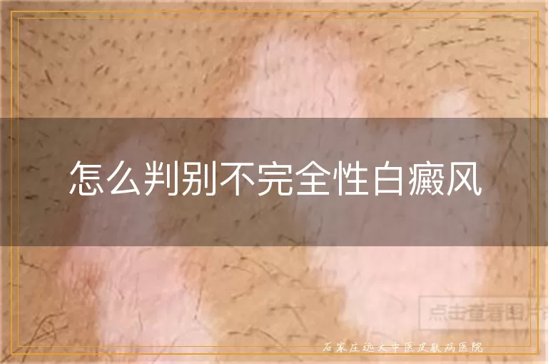 怎么判别不完全性白癜风