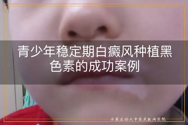 青少年稳定期白癜风种植黑色素的成功案例