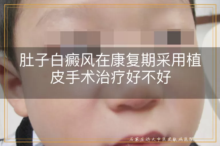 肚子白癜风在康复期采用植皮手术治疗好不好