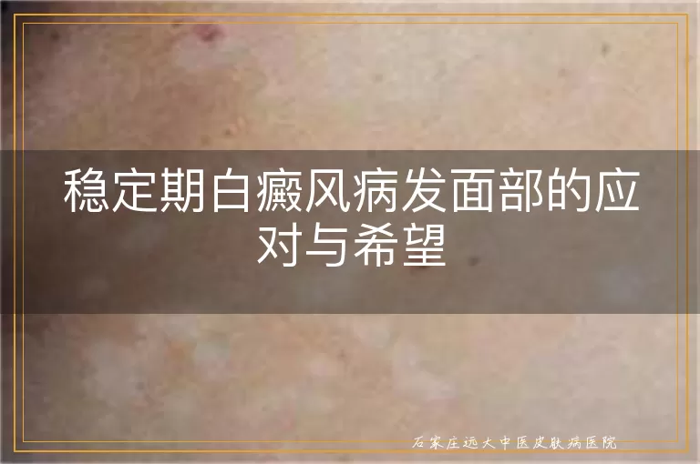 稳定期白癜风病发面部的应对与希望