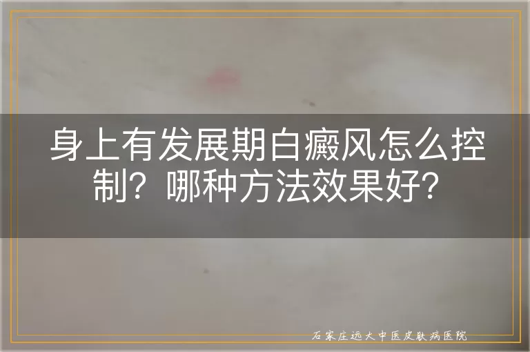身上有发展期白癜风怎么控制？哪种方法效果好？