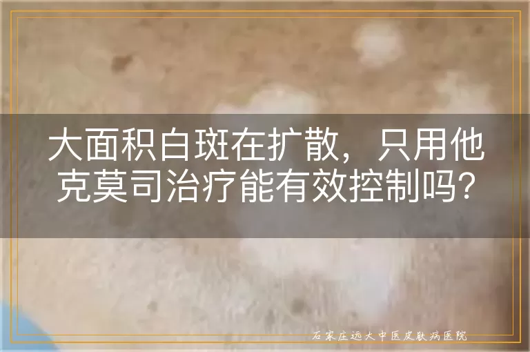 大面积白斑在扩散，只用他克莫司治疗能有效控制吗？